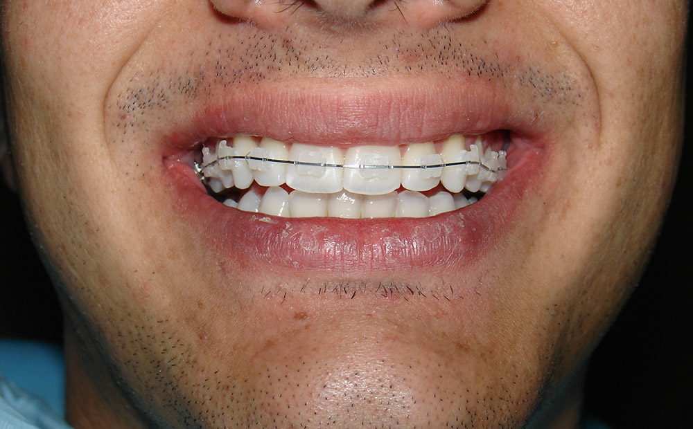 Ortodontia Convencional