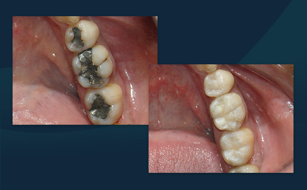 Restaurações Dentais Estéticas